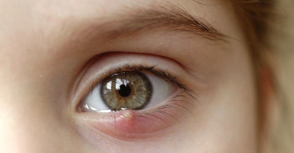 生 眼挑針 與睇污糟嘢多無關 中醫現身解答 Ctgoodjobs Powered By Career Times